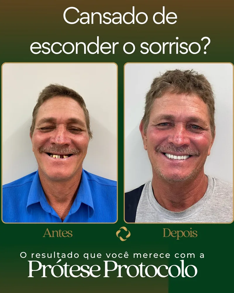 Implantes Dentários