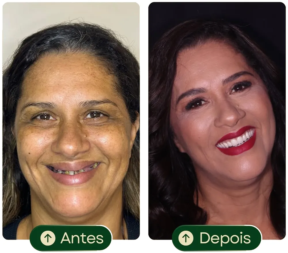 Implantes Dentários