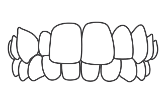 Invisalign - Mordida Cruzada